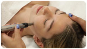 MICRONEEDLING