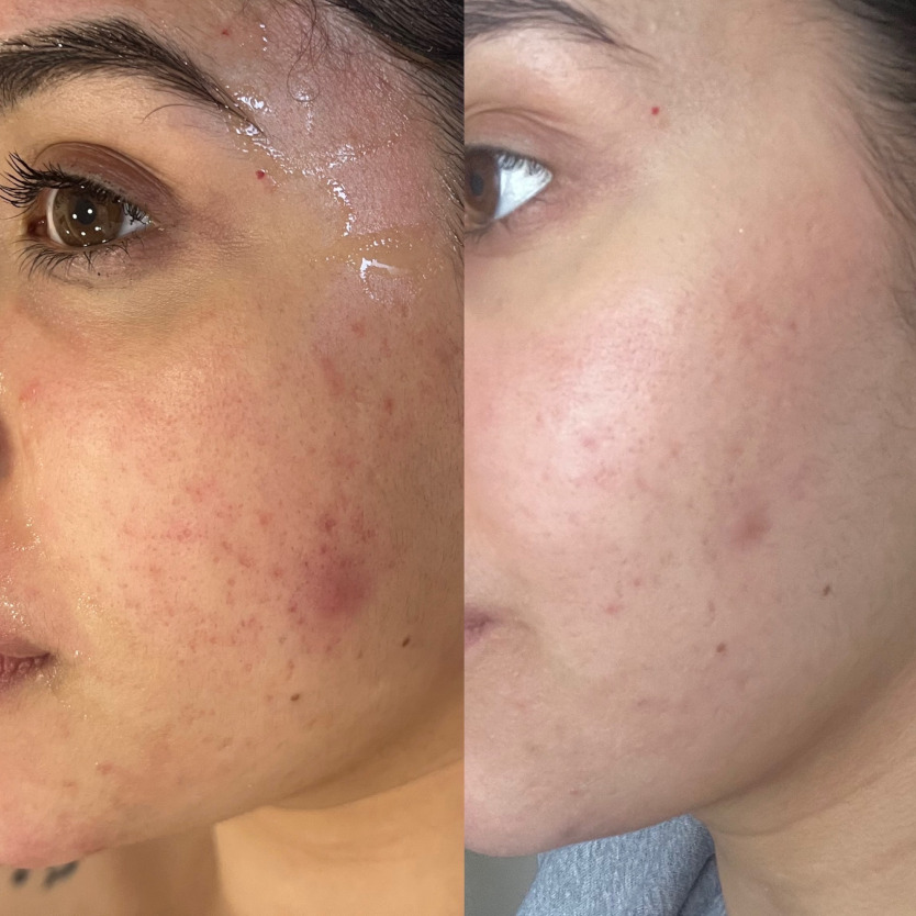 Microneedling Before and After 1 Treatment - What Can 1 Session Do?