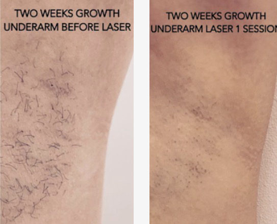 Laser hair removal Primas Medispa