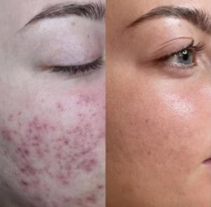 Before After Before After