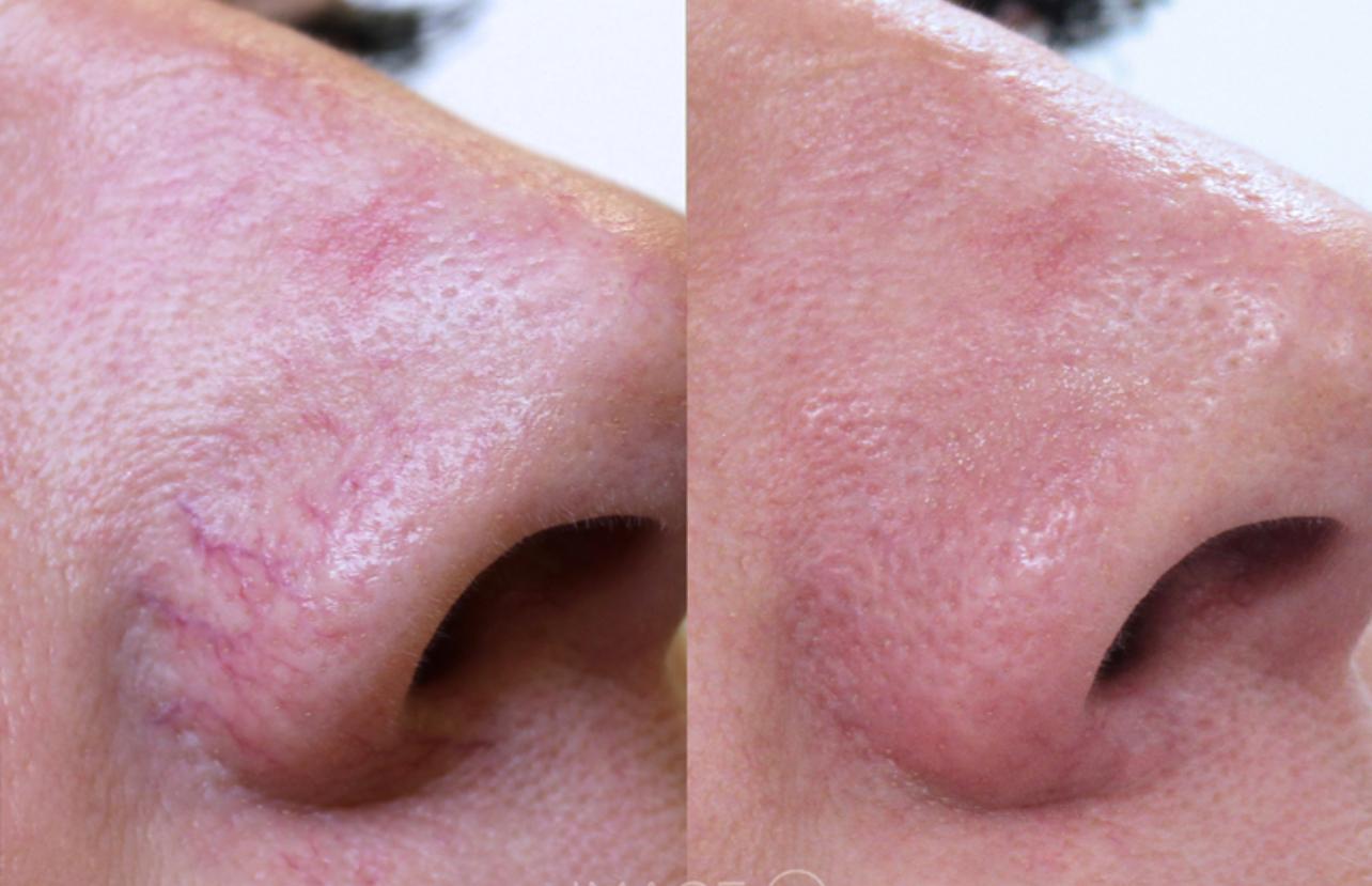 Before and After Laser Veins