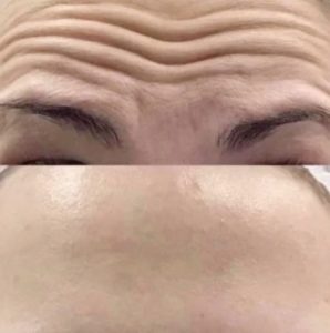 Laser Anti Wrinkle