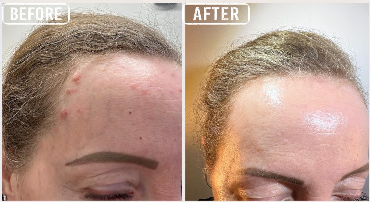 Cryopen Before/After Cryopen Before/After
